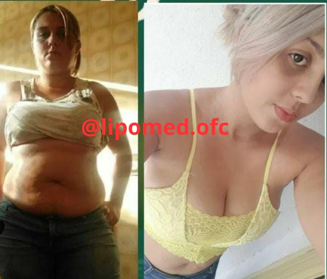 Antes e depois de cliente após uso do LipoMed